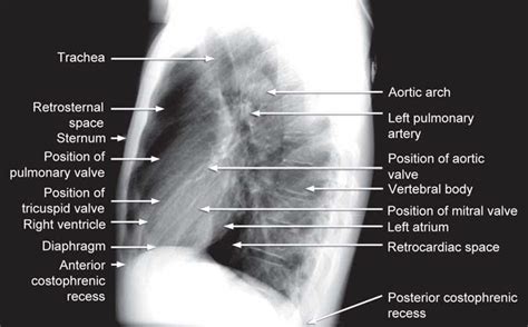 X Ray Chest Anatomy