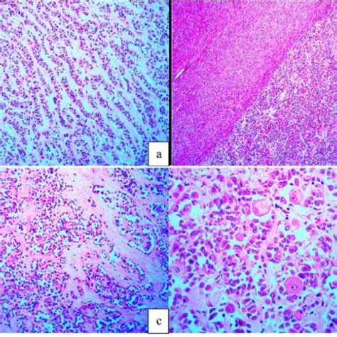 Tumor Characteristically Co Express Melanocytic And Myoid Markers A