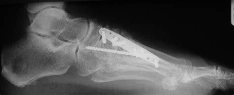 The Surgical Reconstruction Of The Rheumatoid Forefoot Clinics In