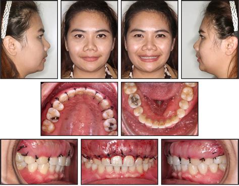 Case Report Jco Online Journal Of Clinical Orthodontics