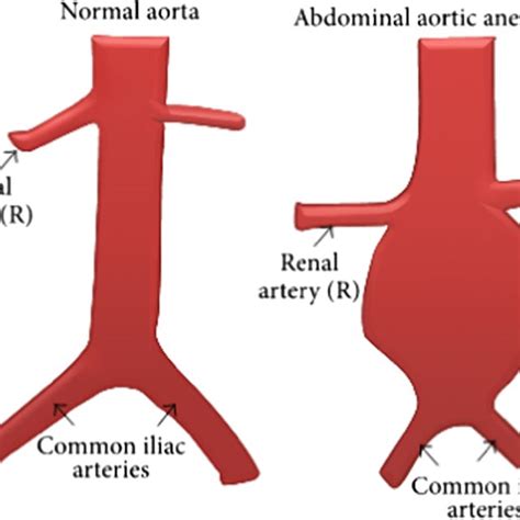 Normal Abdominal Aorta And Abdominal Aortic Aneurysm Download
