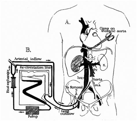 The Official Dr Thomas E Starzl Web Site Surgical Innovations