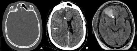 Cerebritis Ct Brain Brain Abscesses Occur Infrequently But Continue To