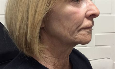 As mentioned before, face threading is a simple, safe, and effective hair removal method that suits all skin types. Photo Gallery | Glo MedSpa: Botox & Juvederm in Scottsdale