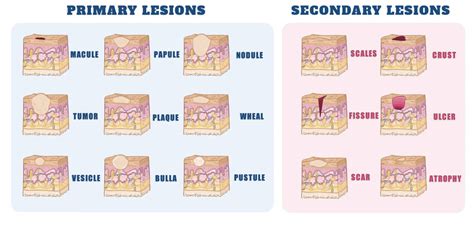 Types Of Skin Lesions Diagnosis Causes Symptoms And Treatment