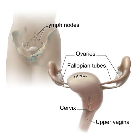 Ovarian Cancer Spread To Lymph Nodes Prognosis Cancerwalls