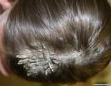 Photos of Psoriasis On Your Scalp Treatment