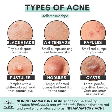 Types Of Acne Types Of Acne Skin Advice Clear Healthy Skin
