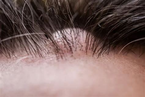 Doctor Warns Of Blood Filled Cysts And Hair Loss As Scalp Popping