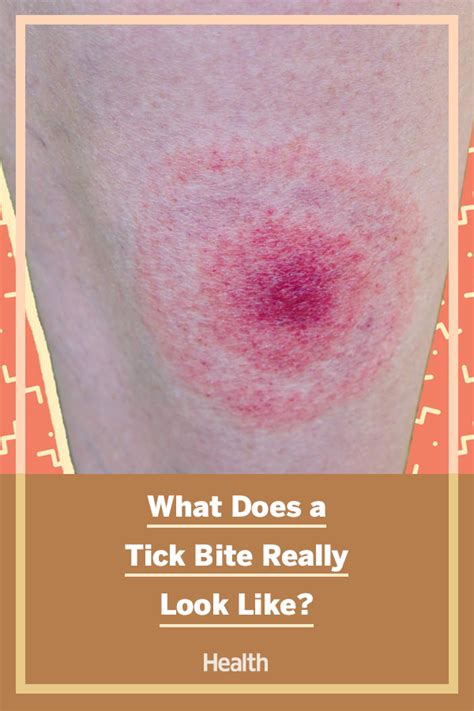 What Does A Tick Bite Look Like Tick Bite Ticks Mosquito Bite
