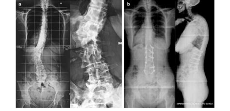 A B Type Iii Dsd In Adult De Novo Lumbar Scoliosis After A Minimally Download Scientific