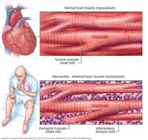 Inflammation Of The Heart Muscle Myocarditis Inflammation Of The