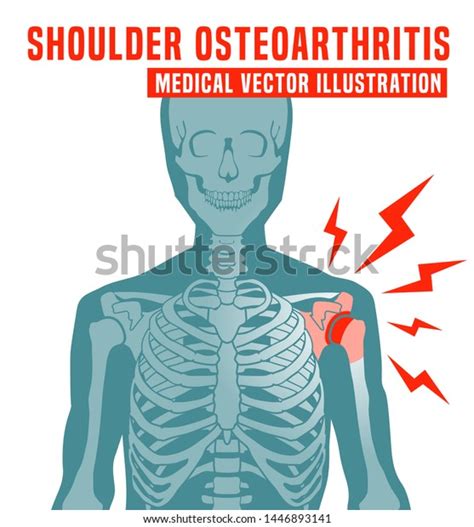 Shoulder Osteoarthritis Image With Skeleton Scheme Spine Bones Injury