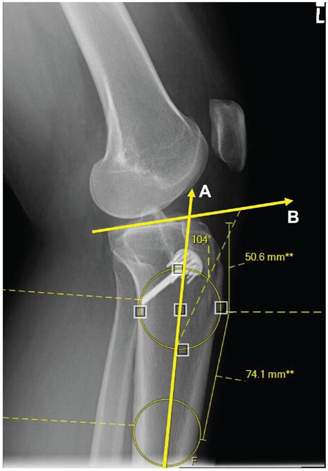 Association Of Elevated Posterior Tibial Slope With Revision Anterior