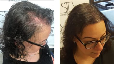 Scalp Micropigmentation For Women Results Before And After Scalp