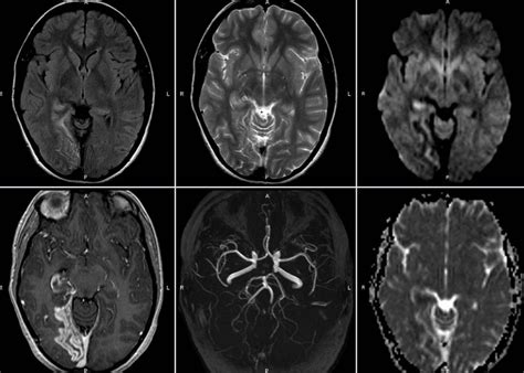 La muerte cerebral o encefálica no es un concepto nuevo, puesto que hace casi 50 años, específicamente en 1968, un comité especializado de la facultad de medicina de la universidad de harvard. ¿Qué es un infarto cerebral? | Pazmental