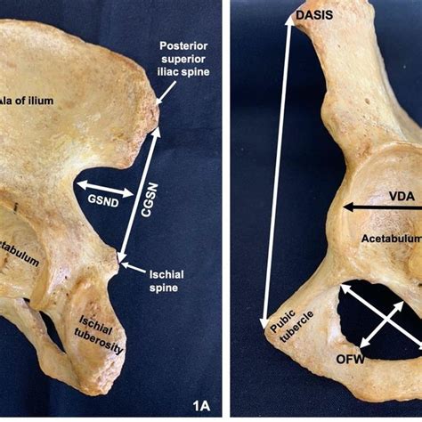 Left Hip Bone Showing Some Relevant Anatomical Structure As Well As The
