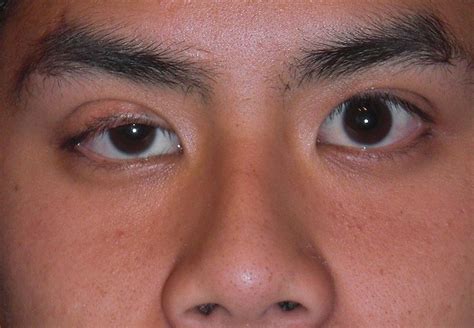 difference between ptosis and blepharoplasty compare the difference between similar terms