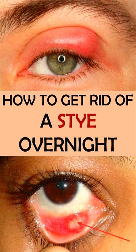 How To Get Rid Of A Stye Overnight Health Stye Remedy Health Remedies