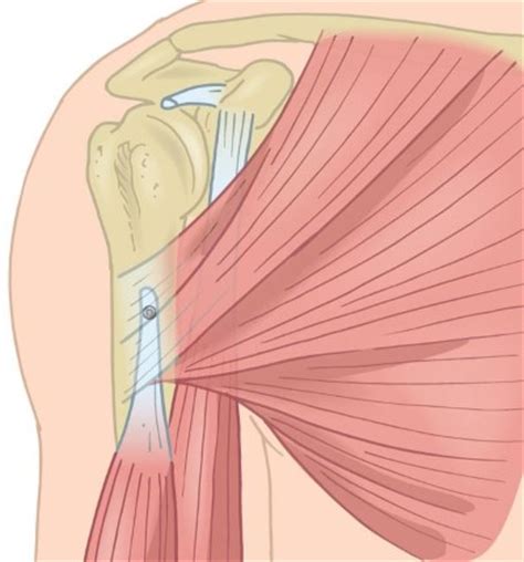 It starts with the biceps long head. Long Head of Biceps Pathology (at shoulder) - Adam Watson ...