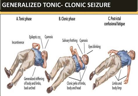 Tonic Clonic Seizure Definition First Aid Causes Symptoms And Treatment
