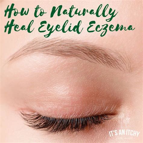 How To Naturally Heal Eyelid Eczema Eczema Around Eyes Eye Eczema