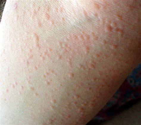 Cold Urticaria Causes Symptoms Diagnosis And Treatment Natural