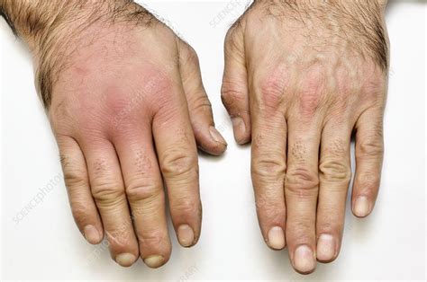 Cellulitis Of The Hand Stock Image C0164802 Science Photo Library