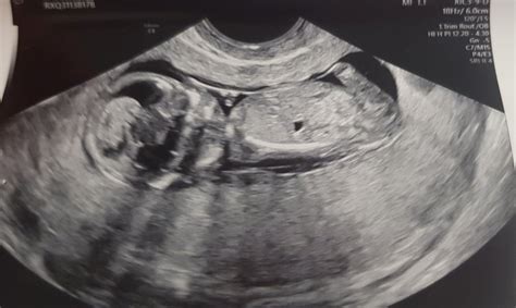Week Scan Retroverted Uterus BabyCentre