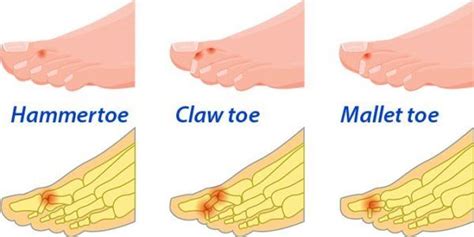 Toe Deformities What You Should Know Arthritis Advisor
