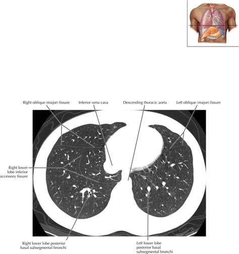 Figure 2 From Pulmonary Vascular Anatomy Anatomical V