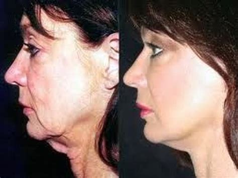 Y lift® & chynjection™ before & after gallery. Best procedure for aging sagging jowls Salt Lake City St ...