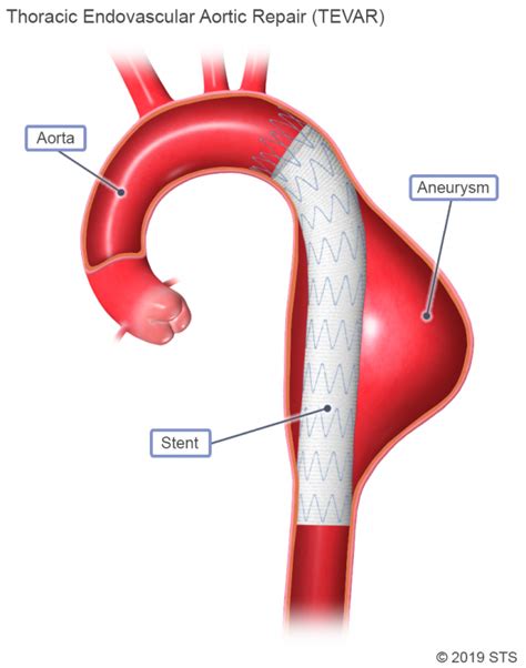 Ascending Thoracic Aortic Aneurysm