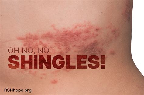 Oh No! Not Shingles! - Renal Support Network