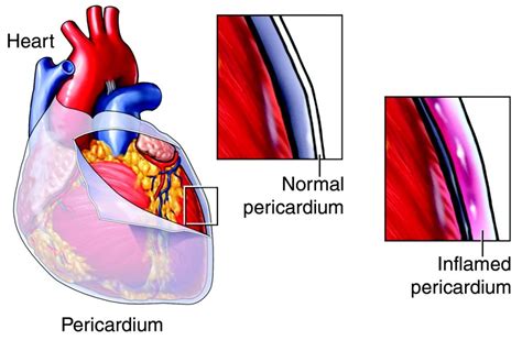 Pericarditis How To Diagnose It Emergency Live