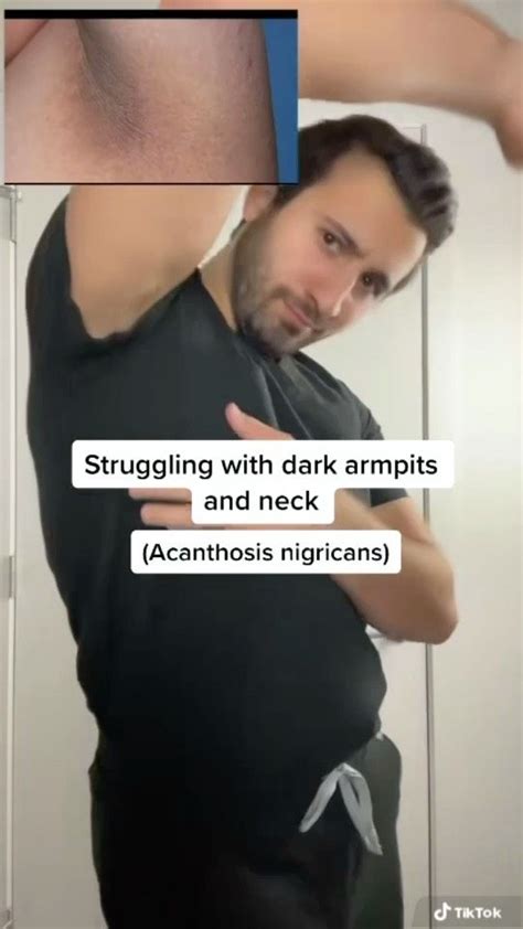 Drtomassian On Instagram Dark Armpits And Neck This Is Called