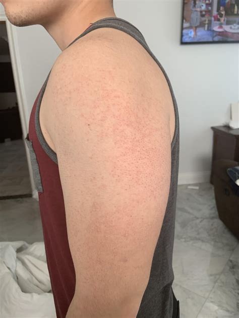 Skin Concerns How Can I Treat These Bumps All Around Both Of My Arms Rskincareaddiction
