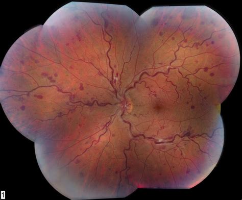 Central Retinal Vein Occlusion Crvo Wills Eye Hospital