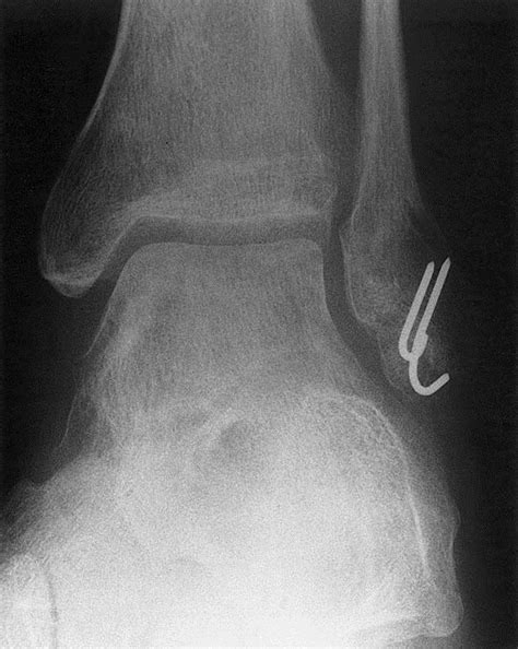 Recurrent Ankle Sprains Secondary To Nonunion Of A Lateral Malleolus