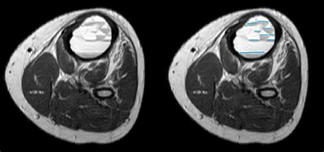 Aneurysmal Bone Cyst Radiology Case