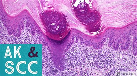 Squamous Cell Carcinoma U0026 Actinic Keratosis 101dermpath Basics