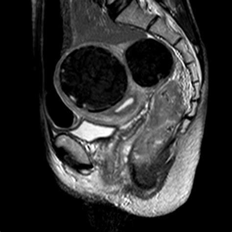 Rectal Cancer T3 And Huge Fibroids Image