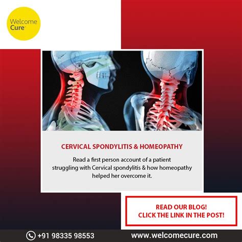 Cervical Spondylitis And Homoeopathy Homeopathy Cervical Muscle Spasm