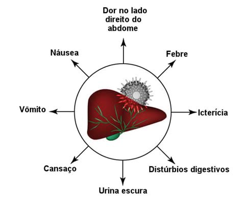 Hepatite A Tipos Causas Sintomas E Tratamentos My Xxx Hot Girl