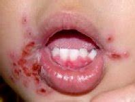Dabei verursachen herpesviren schmerzhafte bläschen im mund. Mundfäule (Stomatitis) bei Babys & Kindern