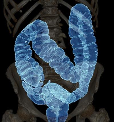 Ct Scan Bowel Hot Sex Picture