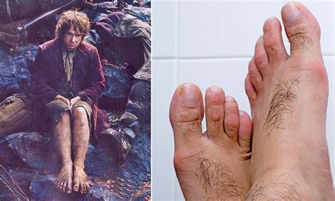 Rising Numbers Of Men Have Laser Treatment To Cure Hairy Hobbit Feet