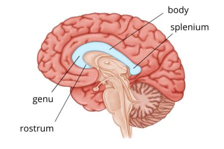 Corpus Callosum Stroke Causes Effects Treatment