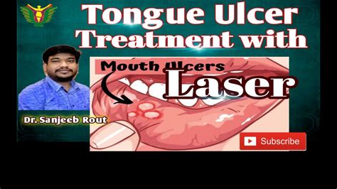 Tongue Ulcer Treatment With Laser Dr Sanjeeb Rout Balaji Skin And