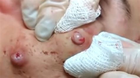 Popping Infected Cystic Acne On Face Youtube Blogdeantonxo